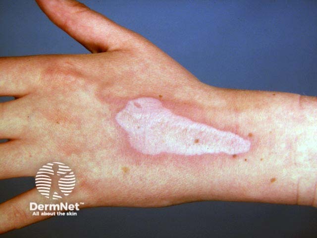 Scar from chemical burn