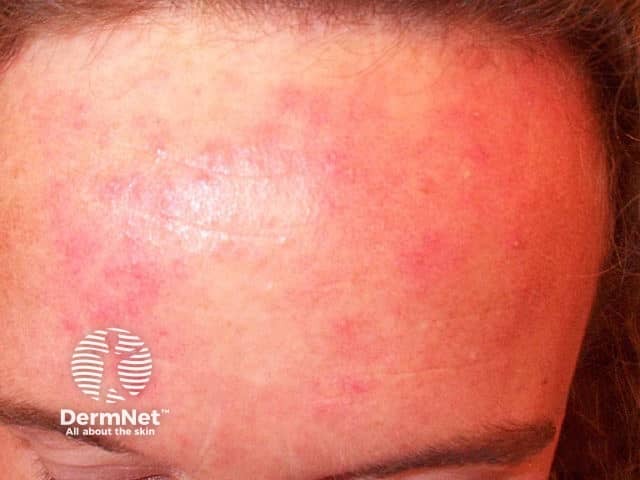 Facial acne