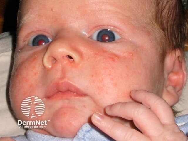Neonatal acne