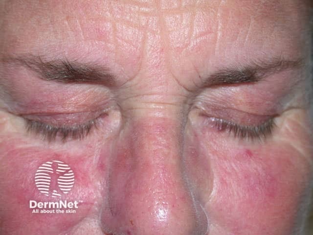 Redness due to steroids