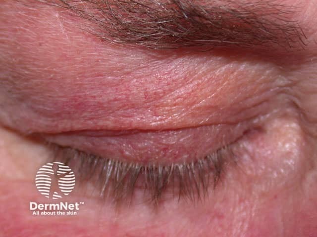 Steroid telangiectasia