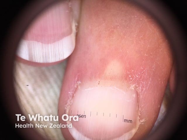 Acrocyanosis