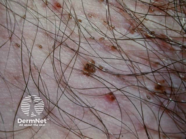 Pubic lice