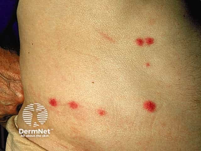 Flea bites