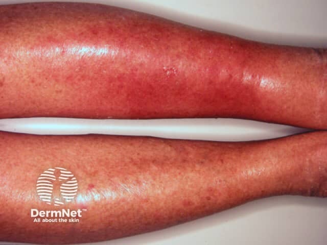 Cellulitis