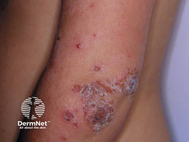 Impetigo