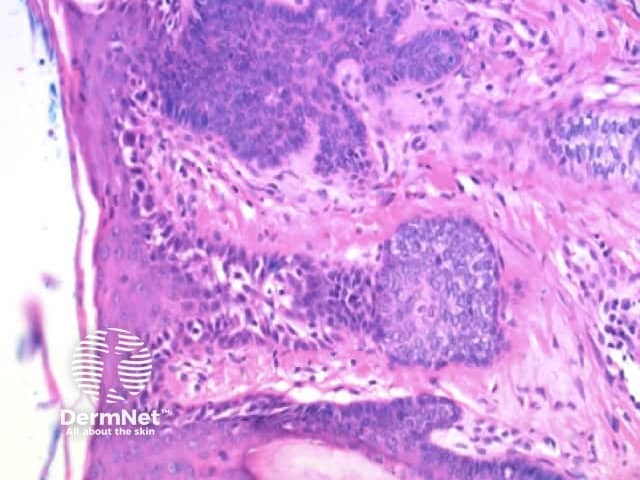 Involvement of follicular infundibula displays as circles on dermoscopy