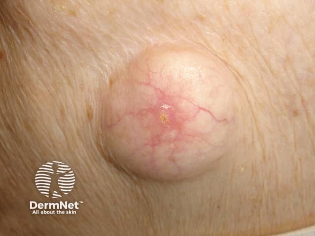 Epidermal cyst