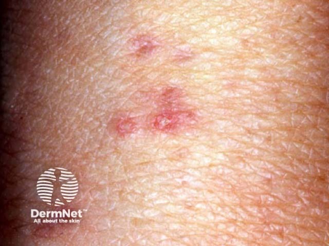 Degos disease