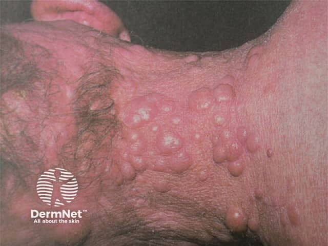 FC lymphoma