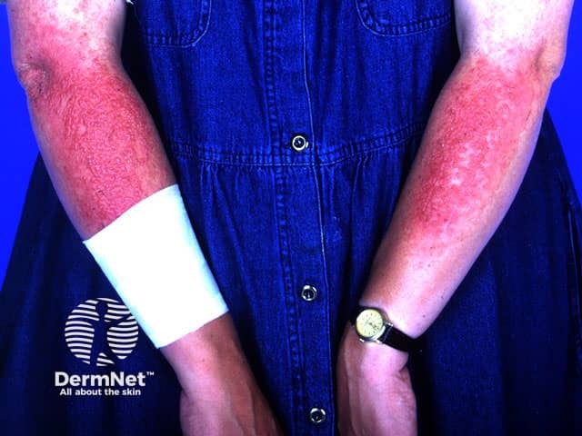 Photocontact dermatitis