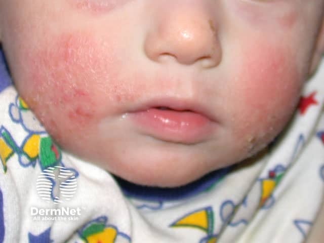 Atopic eczema