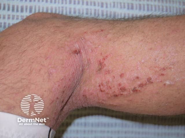 Atopic dermatitis