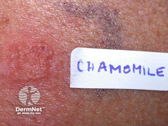 Patch test