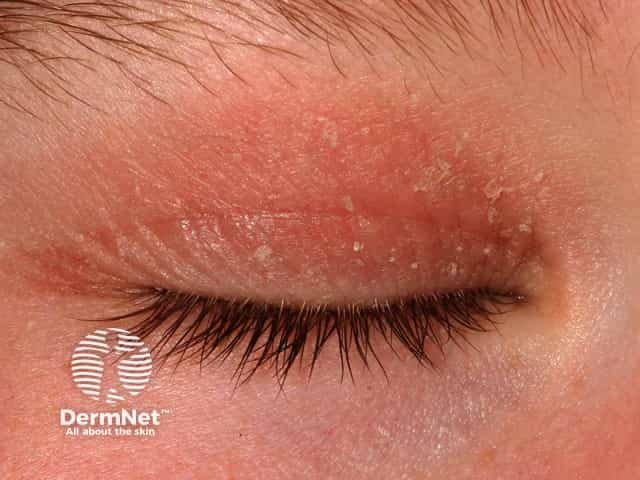 Eyelid contact dermatitis