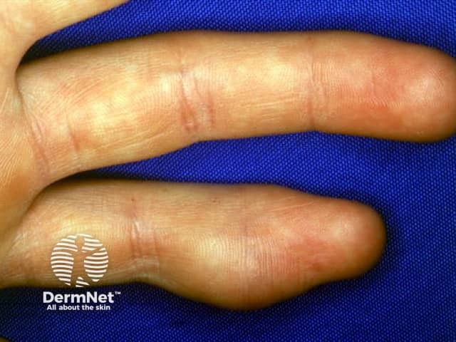 Dermoid cyst