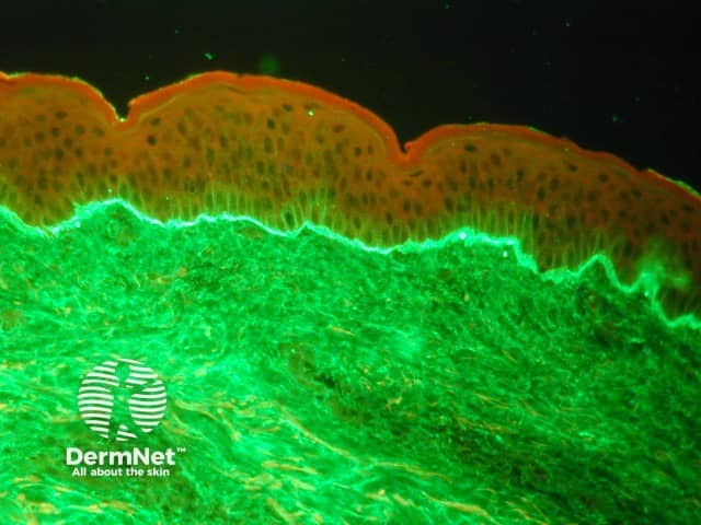 Linear IgA bullous dermatosis