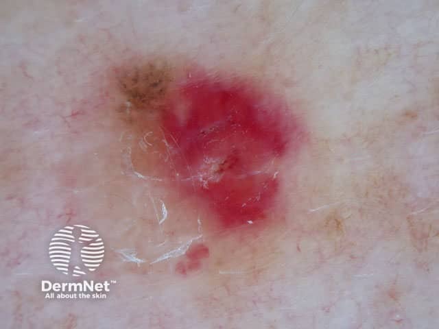 Pigment remnants