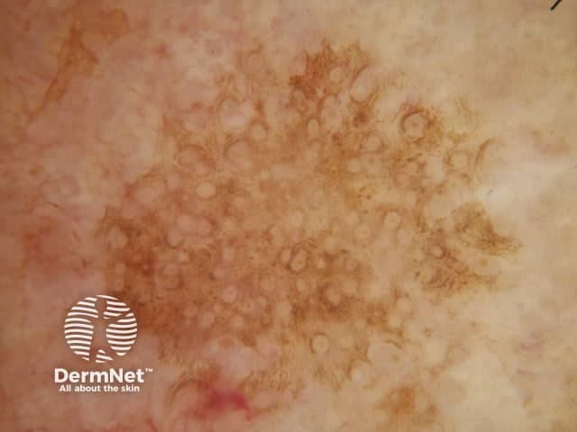 Grey circles seen in dermoscopy of a facial solar lentigo