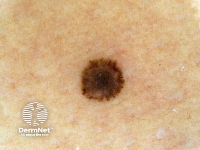 Reed naevus dermoscopy showing starburst pattern