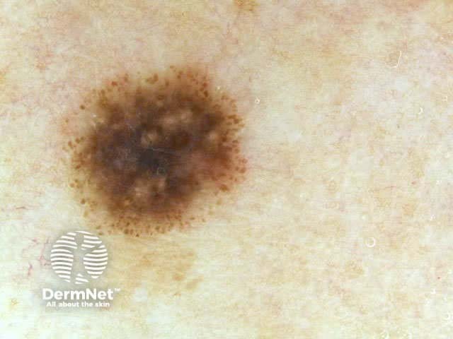 Spitz naevus (pigmented) dermoscopy
