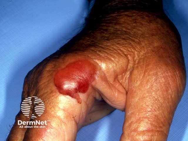 Pseudoporphyria