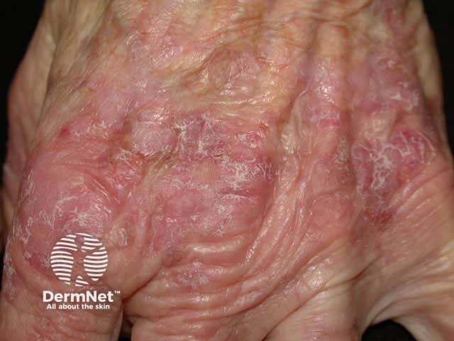 Actinic keratosis