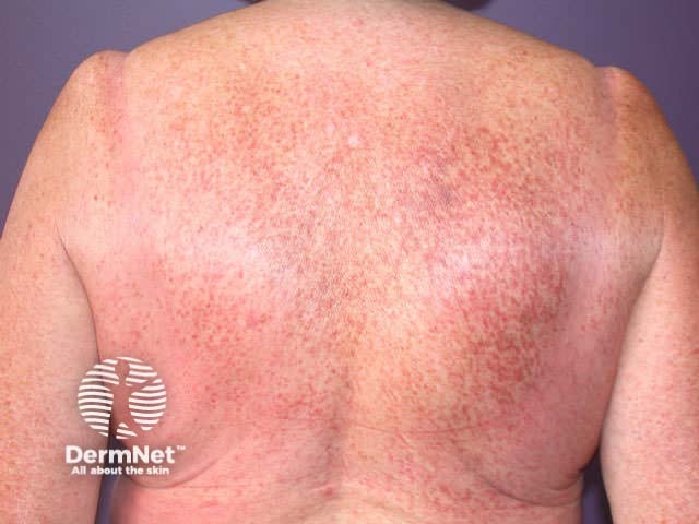 Telangiectasia in maculopapular cutaneous mastocytosis