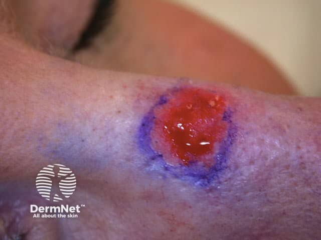 Lesion scraped