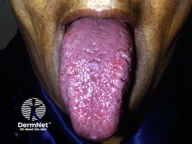 Macroglossia in systemic amyloidosis