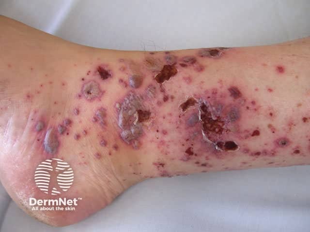 Hypersensitivity vasculitis