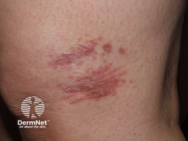 Scar sarcoidosis
