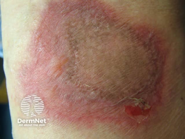 Fixed drug eruption