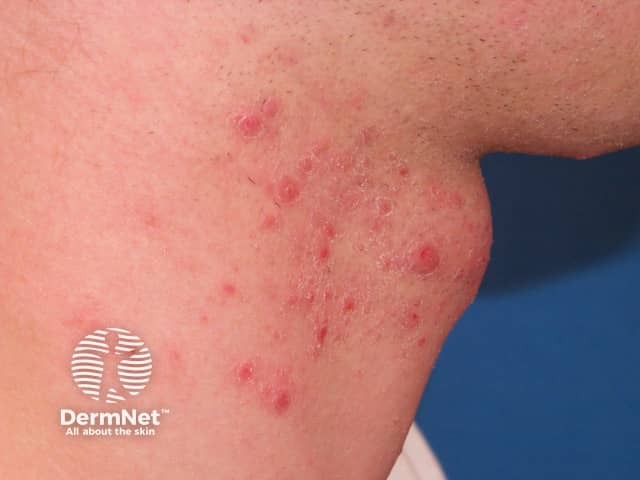 Folliculitis barbae on the neck
