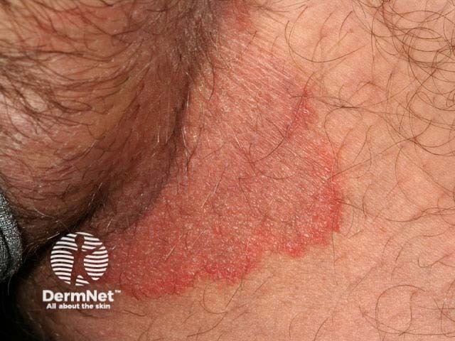 Tinea cruris