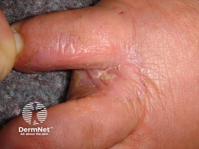 Tinea pedis