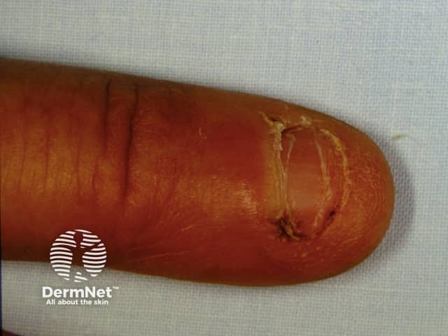 Onychophagia