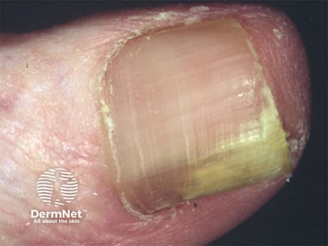 Onychomycosis
