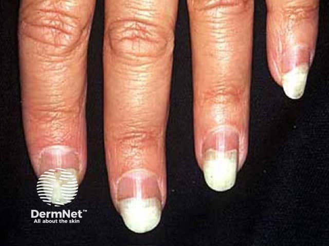 Photo-onycholysis