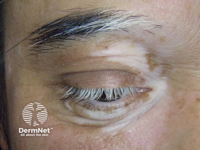 Poliosis