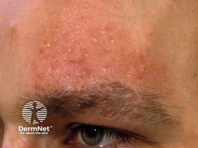 Alopecia mucinosa