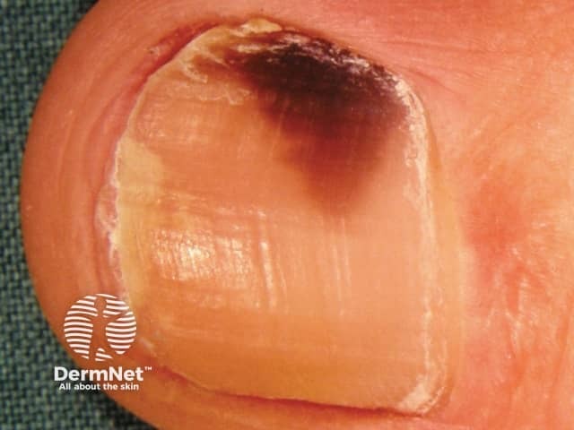 Subungual haematoma