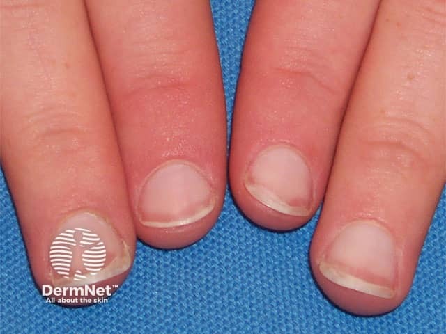 Terry nails