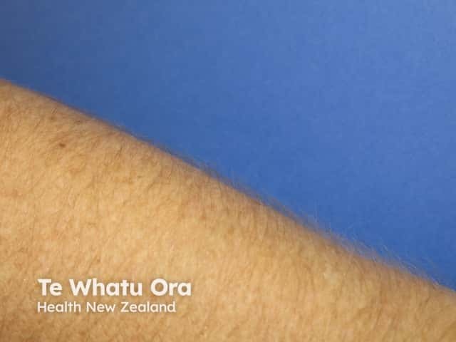 Hypertrichosis
