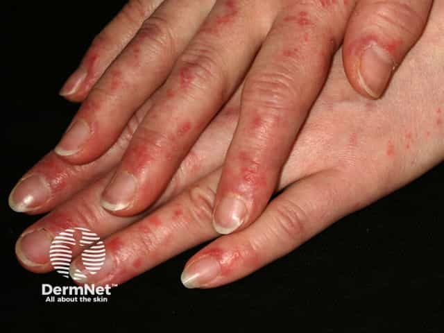 Sparing of knuckles