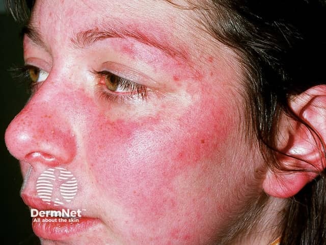 Butterfly rash