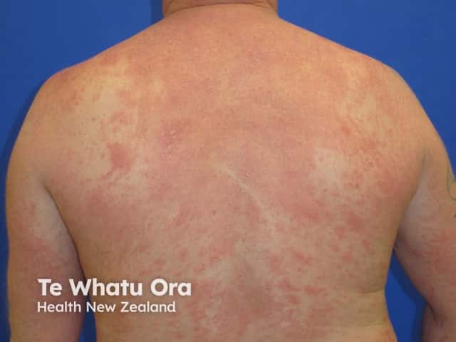 Dermatitis