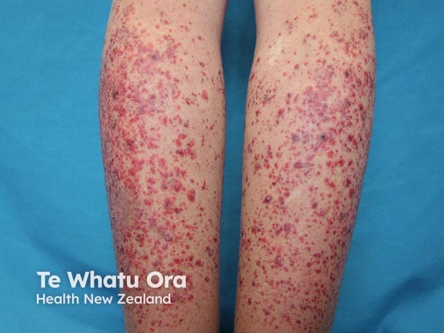 Palpable purpura