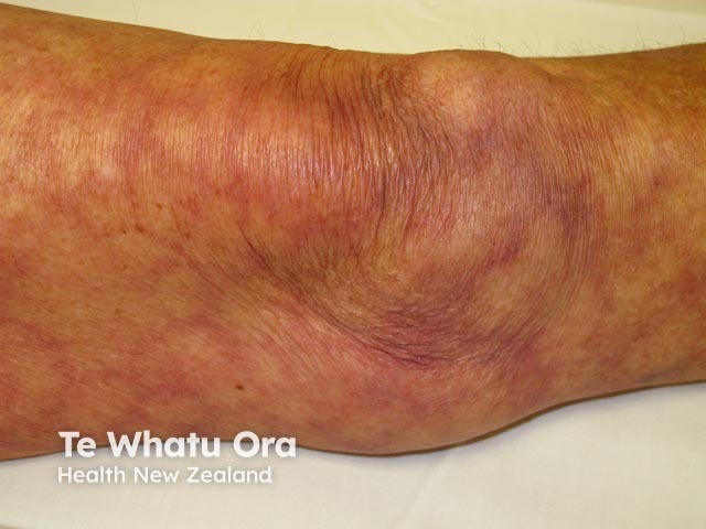 Livedo reticularis