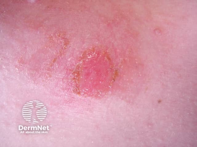 Impetigo